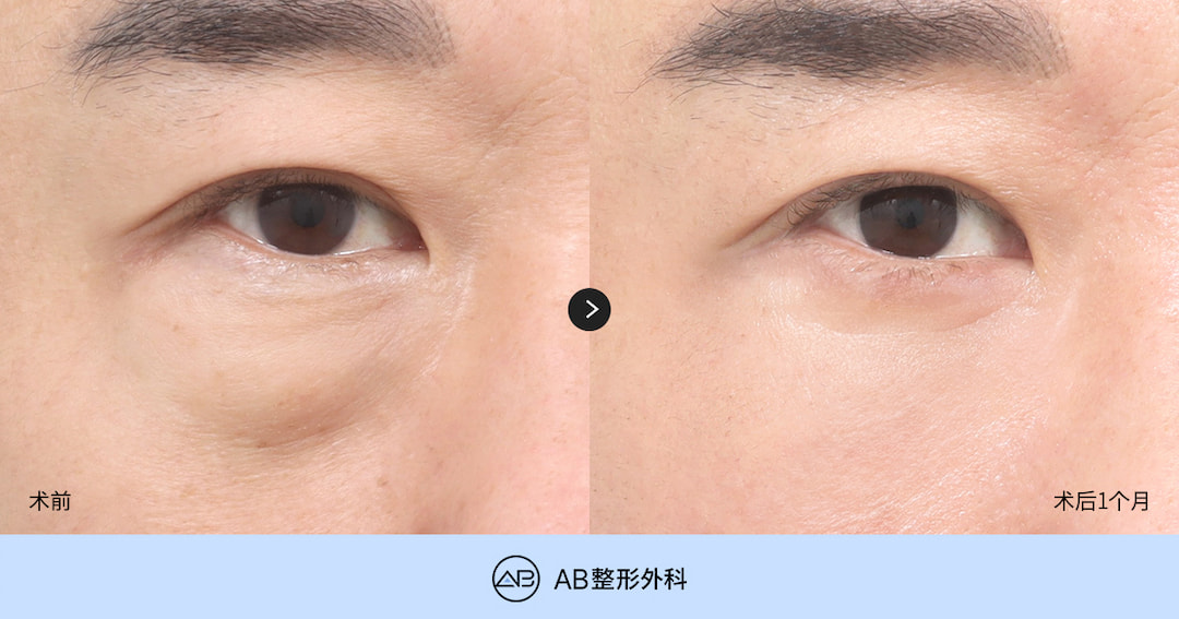 韩国下眼睑手术和眼袋脂肪重置哪个好？40岁眼袋改善指南｜AB整形外科