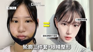 完整變身！雙眼皮矯正+輪廓三件套+眼部開大手術後驚人蛻變