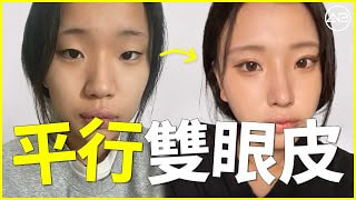 [韓國整形] 外開式雙眼皮，並加入內眼角開放手術效果。| 整形前後對比