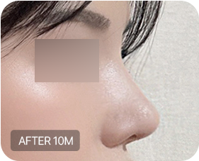Before and after 2-3