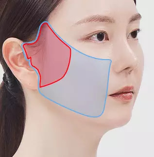 半脸SMAS面部提升术