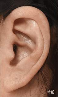 疤痕恢复过程 1