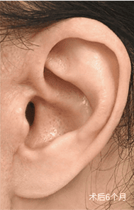 疤痕恢复过程 3