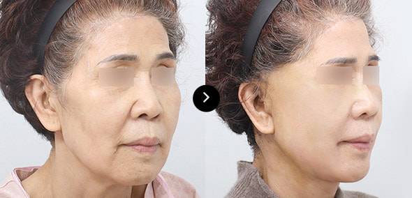 全脸SMAS提升 image 1