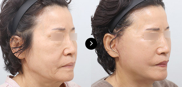 全脸SMAS提升 image 2