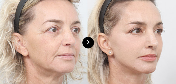 全脸SMAS提升 image 3