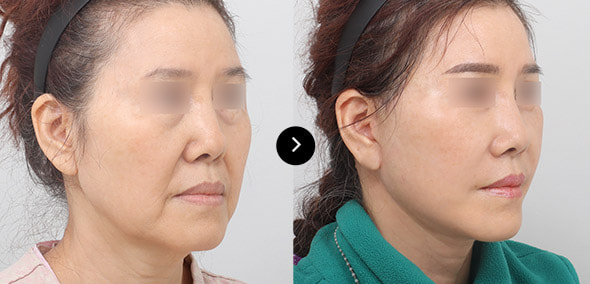 全脸SMAS提升 image 4