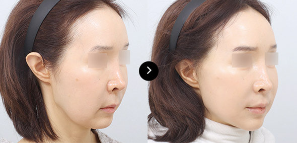 全脸SMAS提升 image 5