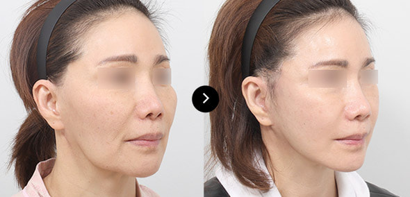 全脸SMAS提升 image 6