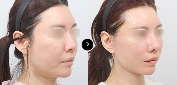 半脸SMAS提升 image 1