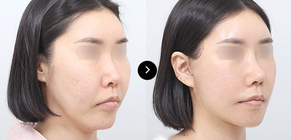 半脸SMAS提升 image 2