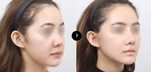 半脸SMAS提升 image 3