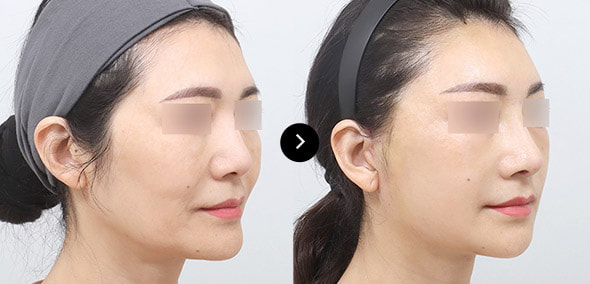 半脸SMAS提升 image 4