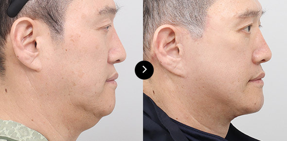 颈部提升 image 1