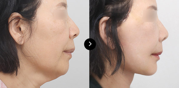 颈部提升 image 2