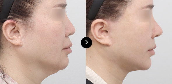 颈部提升 image 3