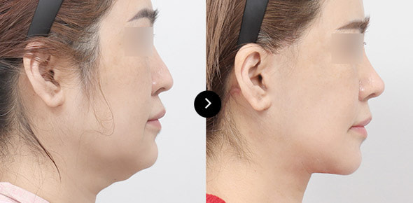 颈部提升 image 4