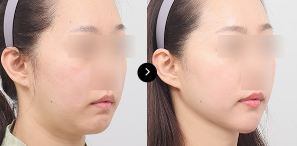 下巴弹力带提升 image 1