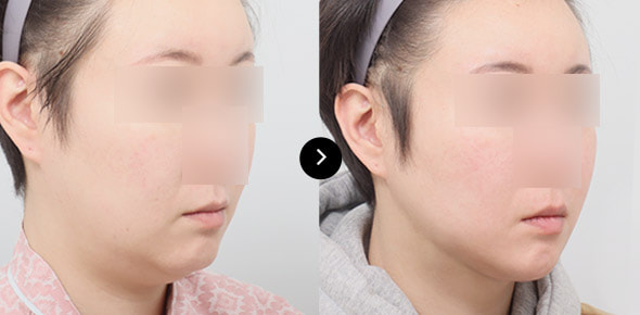 下巴弹力带提升 image 2