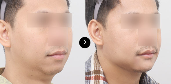 下巴弹力带提升 image 3