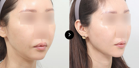 下巴弹力带提升 image 4