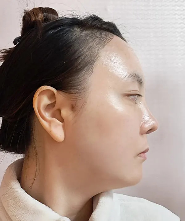 Before and after surgery side view