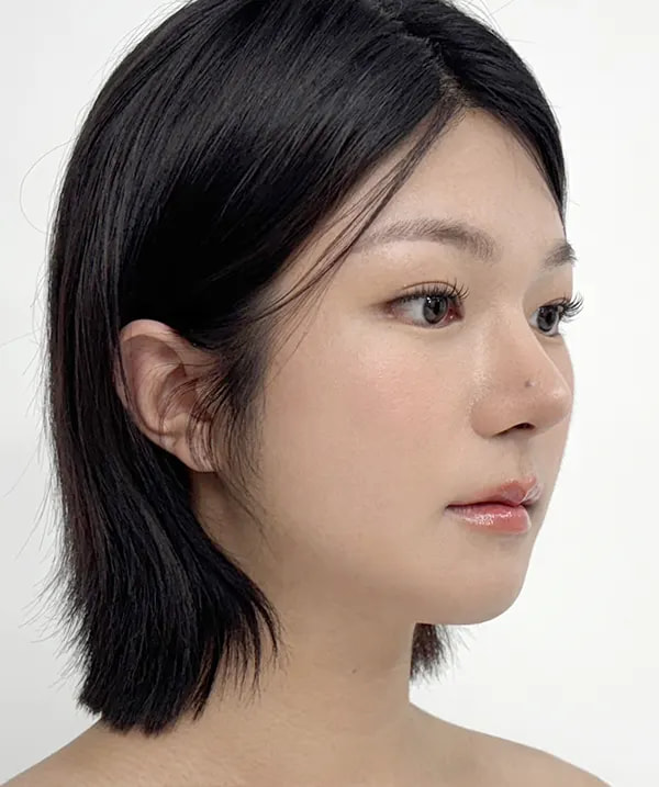 Before and after surgery side view