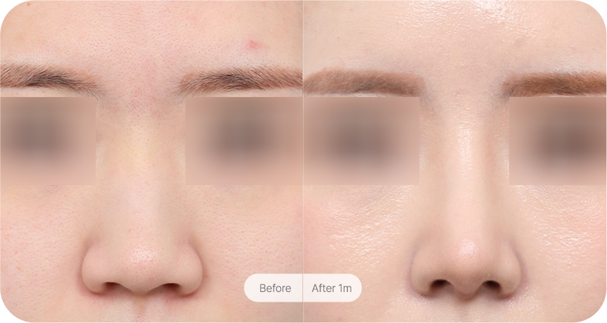 revision-rhinoplasty