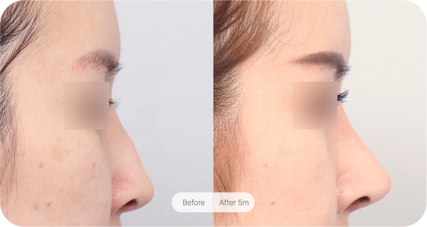 revision-rhinoplasty