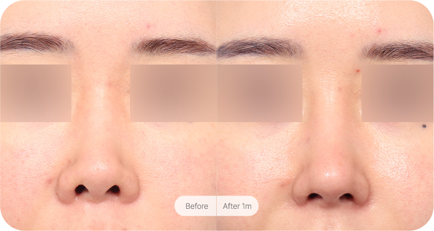 revision-rhinoplasty