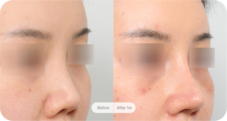 revision-rhinoplasty