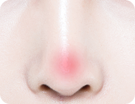 revision-rhinoplasty