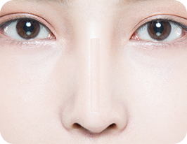 revision-rhinoplasty