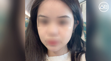 【轮廓三件套&面部补脂&吸脂】 术后3个月【真实后记】