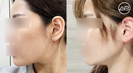 【轮廓三件套+皮肤项目】 术后3个月【真实后记】