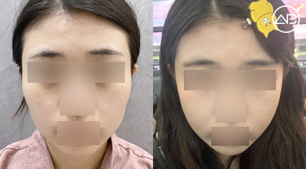 【轮廓两件套+咬肌缩小+劈外板】 术后6个月【真实后记】