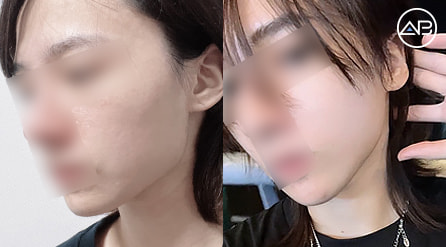 【轮廓三件套+眼底脂肪重置+面部脂肪填充】 术后5个月【真实后记】