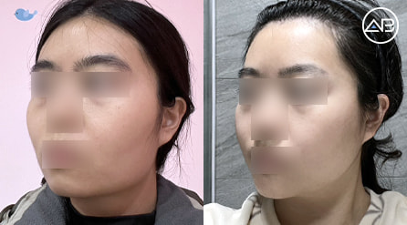 【轮廓三件套】 术后10个月【真实后记】