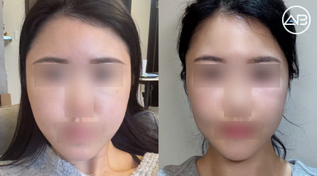 【轮廓三件套+眼修复+面部吸脂】 术后6个月【真实后记】