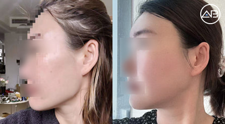 【轮廓三件套】 术后7个月【真实后记】