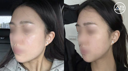 【轮廓两件套+面部吸脂】 术后4个月【真实后记】