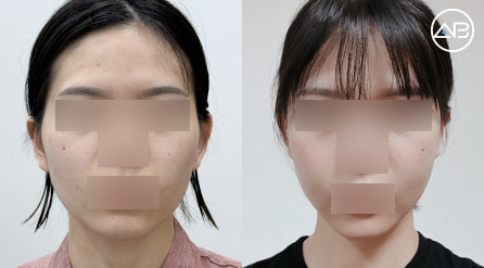 【轮廓三件套】 术后2个月【真实后记】