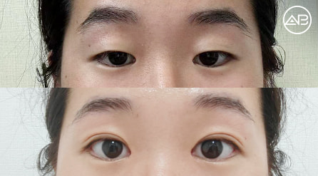【开上眼角+切开法提肌双眼皮】 术后6个月【真实后记】