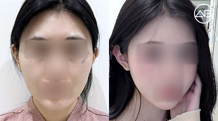 【颧骨内推+取颊脂垫+面部吸脂】 术后1个月【真实后记】