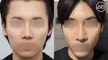 【轮廓两件套+鼻重修】 术后4个月【真实后记】
