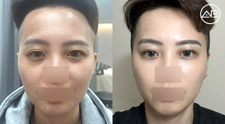 【双眼皮切开+开眼头+开后眼角+下至+脂肪填充】 术后4个月【真实后记】