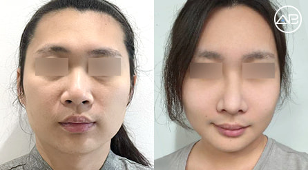 【双眼皮+眼底脂肪重排+鼻综合+补脂+轮廓三件套】 术后2个月【真实后记】