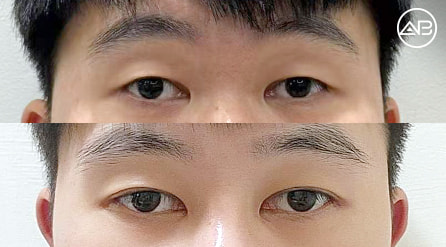 【切开法提肌双眼皮+开眼头+开后眼角+下至】 术后1个月【真实后记】