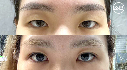 【埋线双眼皮提肌+开眼头】 术后2个月【真实后记】