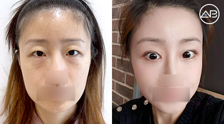 【埋线双眼皮脂肪移植+开眼头+提眉术+眼底脂肪重排+苹果肌脂肪填充】 术后3个月【真实后记】